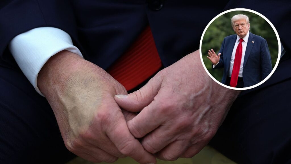 ¿Qué es la insuficiencia venosa crónica?